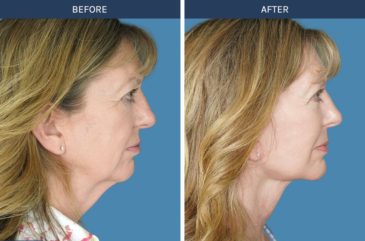 Plane-Face-Lift-with-Deep-Neck-Lift-by--Side-Right Emface results over 6 months: Emface before and after 6 months improved jawline definition and cheek lift in a woman in her 40s, Midtown NYC